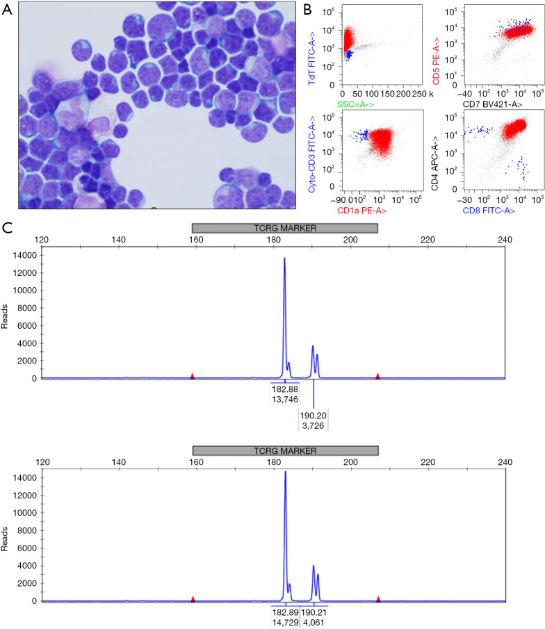 Co-occurrence of thymoma and acute T-lymphoblastic leukemia/lymphoma: a case report and literature review.