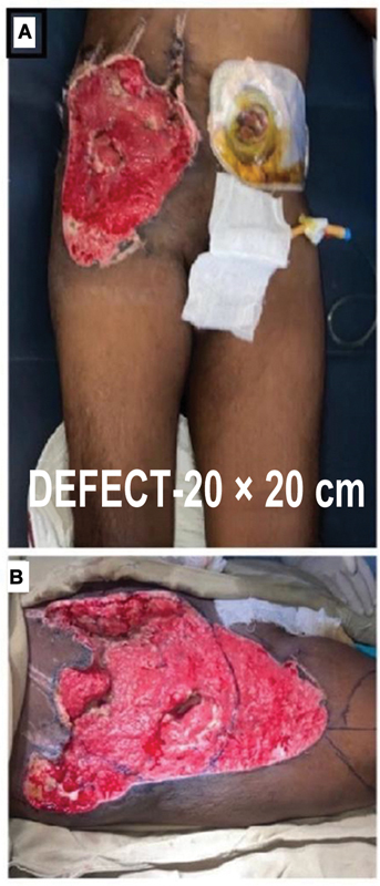 Anterolateral Thigh Flap for Abdominal Wall Reconstruction: A Lifesaving Procedure-A Case Report.