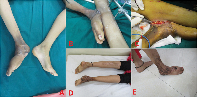 Use of Muscle Interpolation Flap as a Reconstructive Option in Soft Tissue Coverage of Limbs: A Novel Technique.