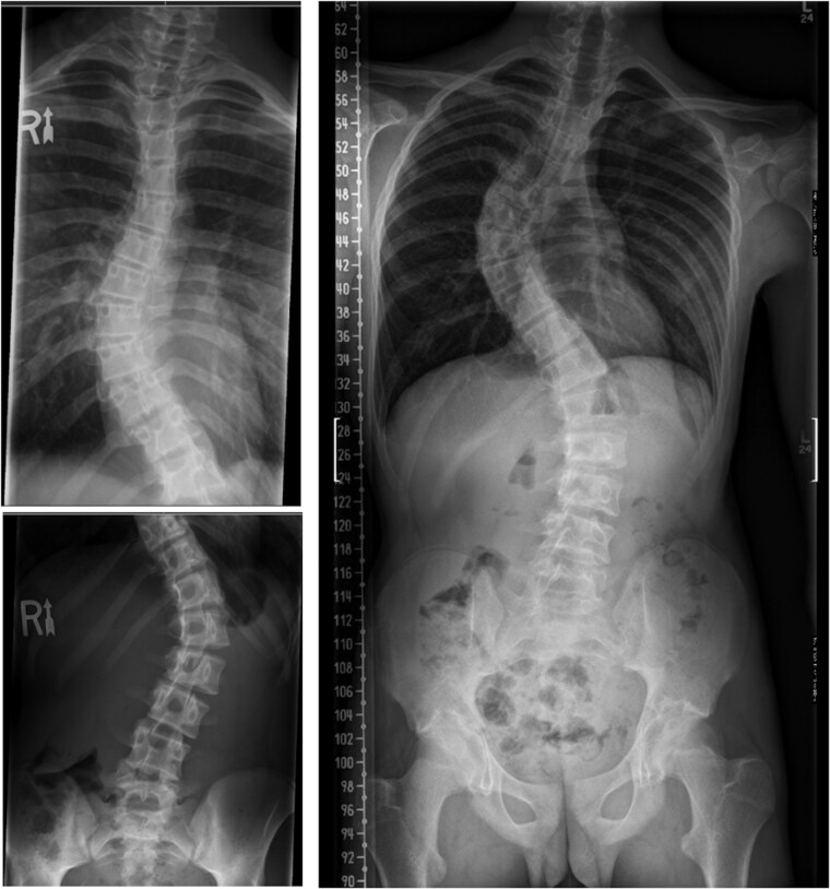 Radiographic reporting in adolescent idiopathic scoliosis: Is there a discrepancy comparing radiologists' reports and surgeons' assessments?
