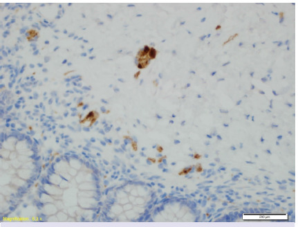 Full-thickness rectal biopsies in diagnosis of Hirschsprung disease: 13 years of experience of a single center.