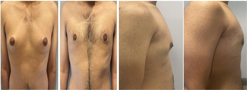 Using Ultrasound and Power-Assisted Devices through Lateral Incision: The OCCULT Technique for Gynecomastia-A Multicentric Large Series Study.