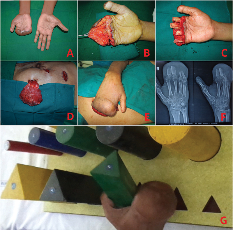 Use of Muscle Interpolation Flap as a Reconstructive Option in Soft Tissue Coverage of Limbs: A Novel Technique.