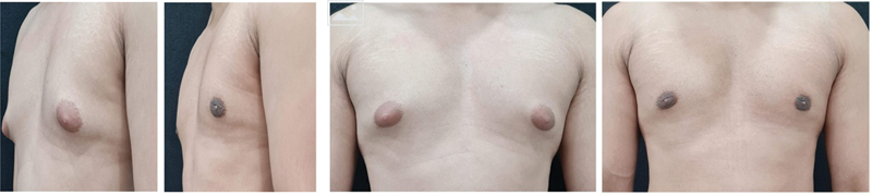 Using Ultrasound and Power-Assisted Devices through Lateral Incision: The OCCULT Technique for Gynecomastia-A Multicentric Large Series Study.