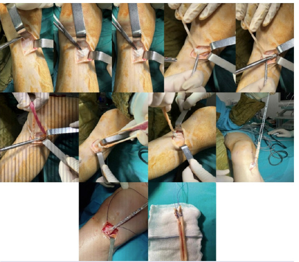 The new auto graft technique in anterior cruciate ligament reconstruction.