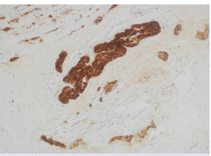 Full-thickness rectal biopsies in diagnosis of Hirschsprung disease: 13 years of experience of a single center.