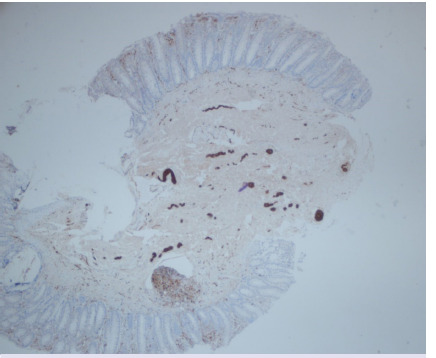 Full-thickness rectal biopsies in diagnosis of Hirschsprung disease: 13 years of experience of a single center.
