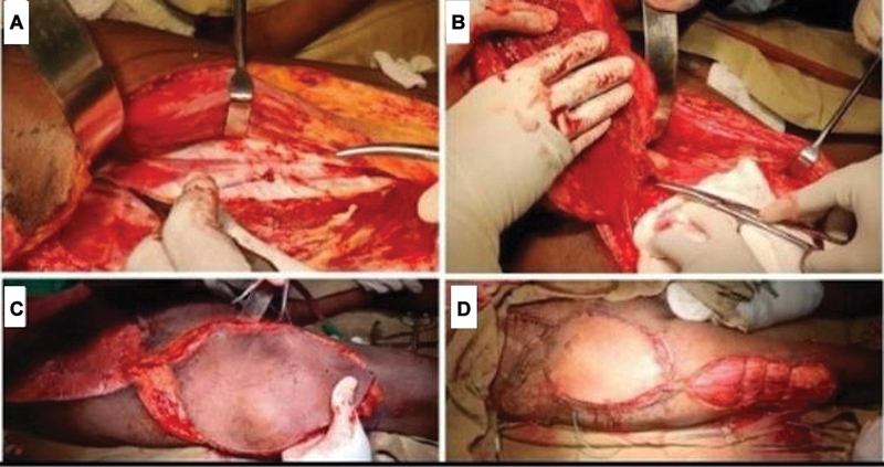 Anterolateral Thigh Flap for Abdominal Wall Reconstruction: A Lifesaving Procedure-A Case Report.