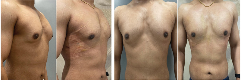 Using Ultrasound and Power-Assisted Devices through Lateral Incision: The OCCULT Technique for Gynecomastia-A Multicentric Large Series Study.