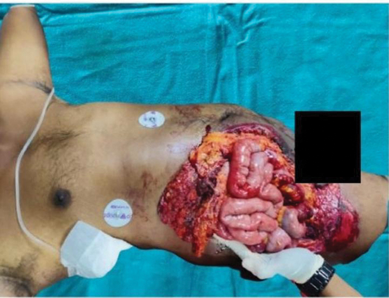 Anterolateral Thigh Flap for Abdominal Wall Reconstruction: A Lifesaving Procedure-A Case Report.
