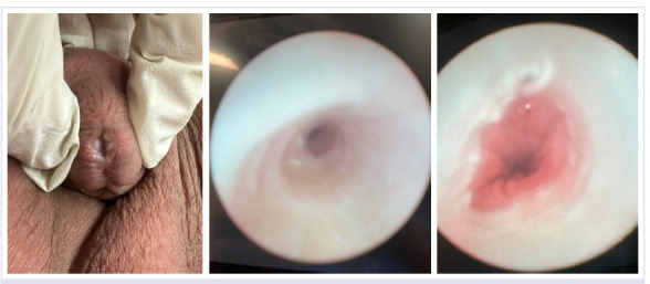 Idiopathic urethritis in pediatric males: A 13-year experience with and without steroid injection.