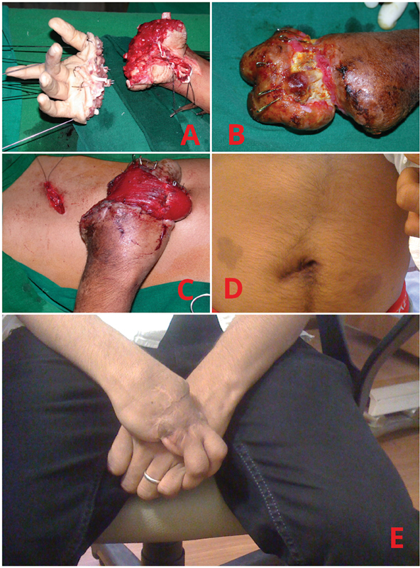Use of Muscle Interpolation Flap as a Reconstructive Option in Soft Tissue Coverage of Limbs: A Novel Technique.