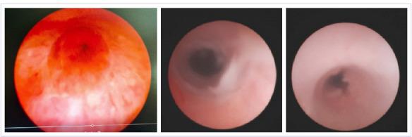 Idiopathic urethritis in pediatric males: A 13-year experience with and without steroid injection.