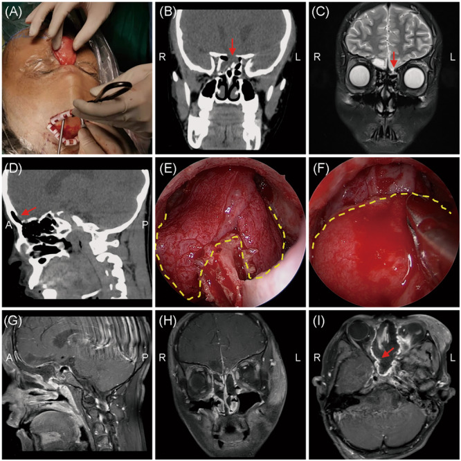 Clinical characteristics and surgical outcomes between traumatic and nontraumatic cerebrospinal fluid rhinorrhea.