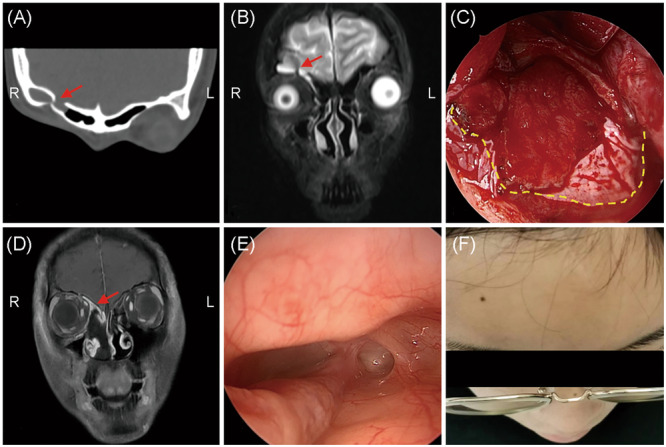 Clinical characteristics and surgical outcomes between traumatic and nontraumatic cerebrospinal fluid rhinorrhea.