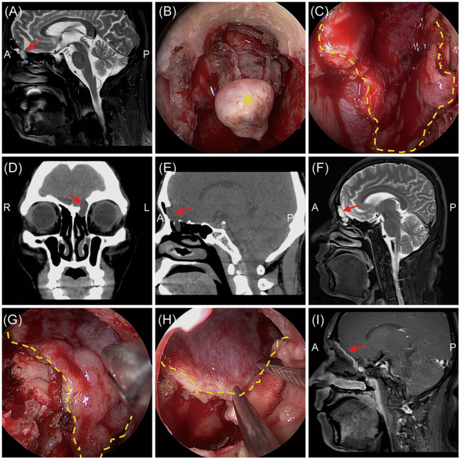 Clinical characteristics and surgical outcomes between traumatic and nontraumatic cerebrospinal fluid rhinorrhea.