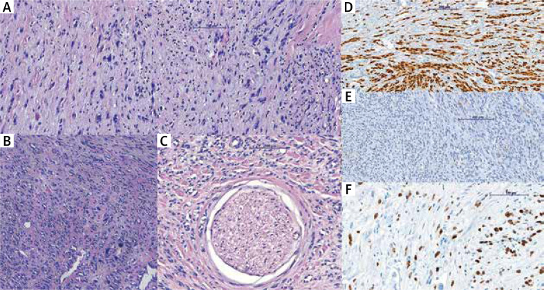 Dermoscopy of a giant desmoplastic melanoma coexistent with rectal adenocarcinoma: a synchronous double primary malignancy.