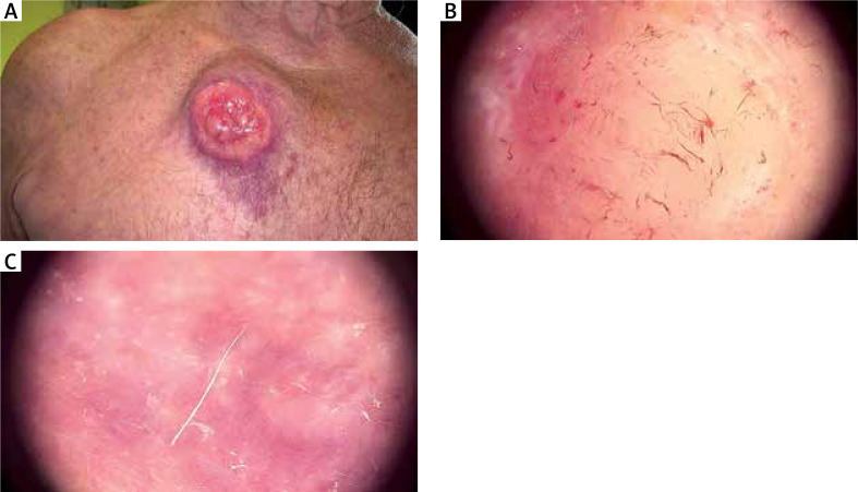 Dermoscopy of a giant desmoplastic melanoma coexistent with rectal adenocarcinoma: a synchronous double primary malignancy.