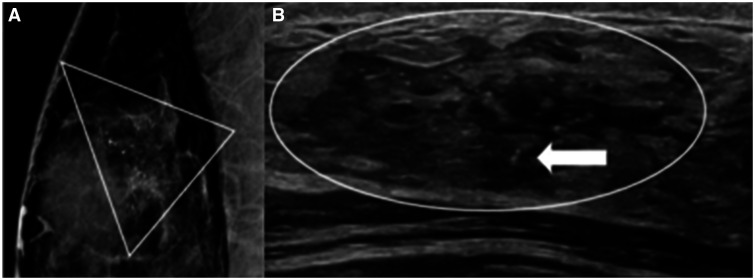 Mitigating overtreatment of ductal carcinoma in situ.