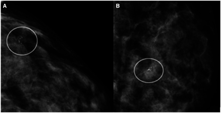 Mitigating overtreatment of ductal carcinoma in situ.