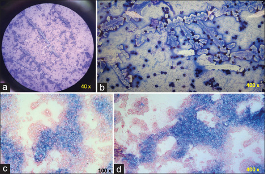 Endophthalmitis after intravitreal injection with or without triamcinolone - A 10-year investigation in a tertiary hospital.