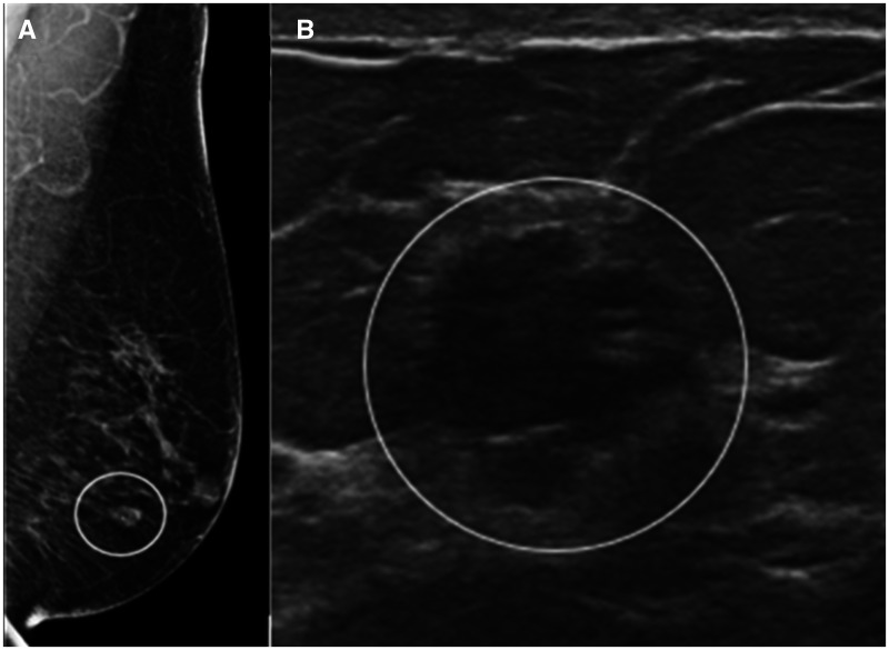 Mitigating overtreatment of ductal carcinoma in situ.