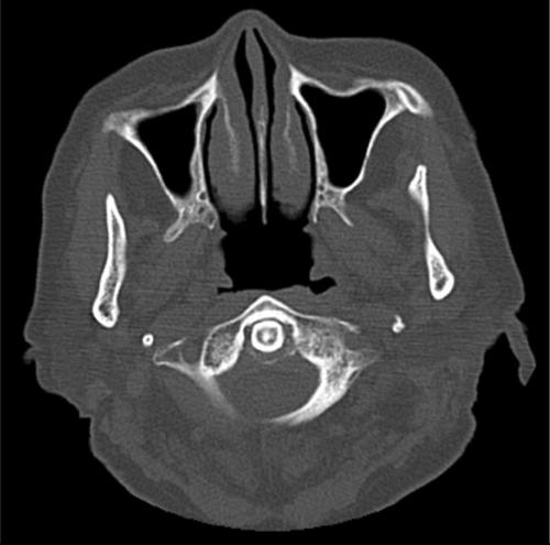 Crowned Dens Syndrome Triggered by Dental Treatment
