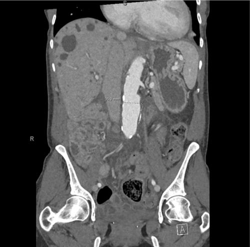 A Challenging Case of Inferior Vena Cava Compression in an Adult Polycystic Kidney Disease Patient. A Case Report