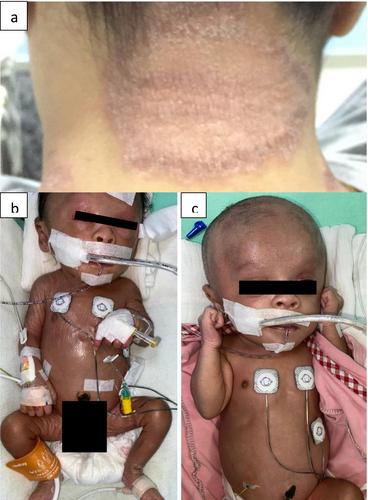 Holocarboxylase Synthetase Deficiency: Clinical, Biochemical and Molecular Findings in Five Malaysian Patients Including a Newborn Presenting as Collodion Baby