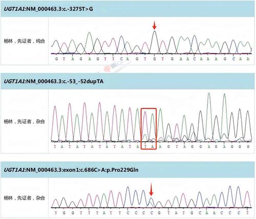 A Case Report of Gilbert Syndrome Presenting With Acute Cholecystitis