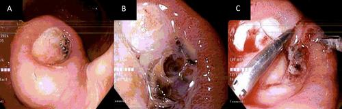 Unusual Presentation of Acute Gastrointestinal Bleeding in Gastric Lipoma and Concomitant Helicobacter pylori Infection: A Case Report