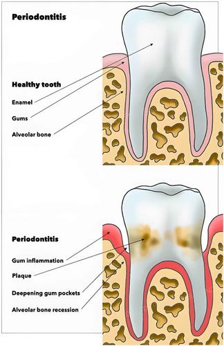 Considerations in the treatment of individuals with obesity and periodontitis