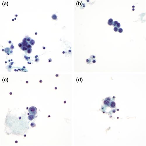 A Case Series and Literature Review of Angiosarcoma With Malignant Effusion—A Challenging Cytologic Diagnosis With Dire Prognostic Implications