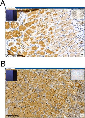 Prognostic Value of CD133 and SOX2 Expression After Neoadjuvant Chemotherapy in Patients With Locally Advanced Gastric Cancer