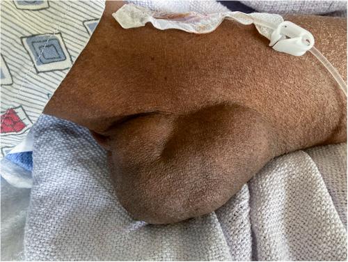 Tophaceous gout