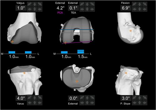 Beyond the coronal plane in robotic total knee arthroplasty—Part 2: Combined flexion does not affect outcomes