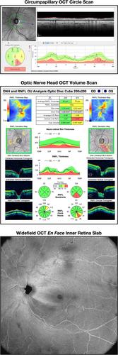 High-Resolution Microperimetry for Detecting Glaucomatous Damage: A Prospective Evaluation of Performance