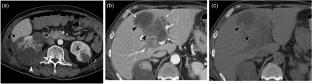 Crizotinib-associated hepatic and renal cysts: a case report with MRI findings
