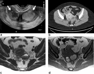 Endometriosis imaging in the community setting: implementation of the SRU consensus recommendations on routine pelvic US