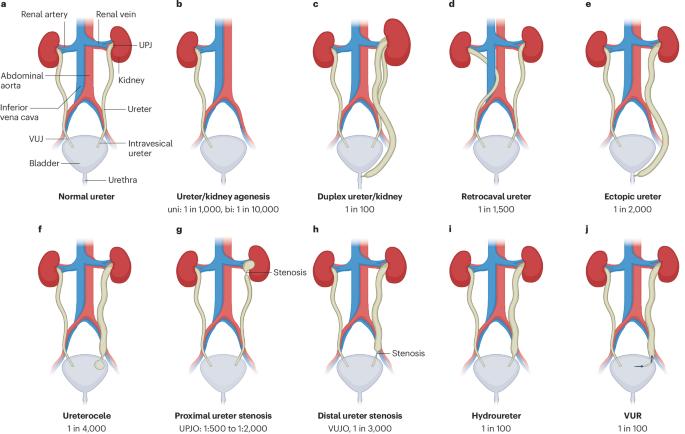 Ureter development and associated congenital anomalies