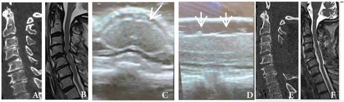 The feasibility and utility of intraoperative ultrasound in spinal cord injury patients: an international survey of AO spine members