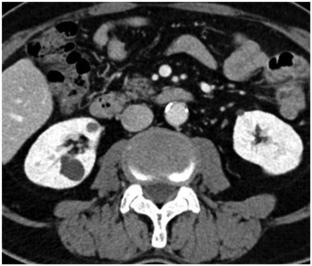 Crizotinib-associated hepatic and renal cysts: a case report with MRI findings