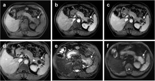 Correlation of MRI characteristics with KRAS mutation status in pancreatic ductal adenocarcinoma