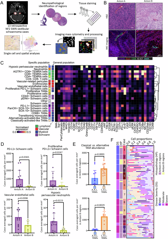 Spatial mapping of immune cell environments in NF2-related schwannomatosis vestibular schwannoma