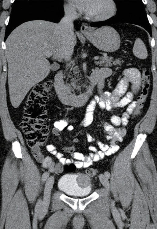 Robot‑assisted resection of a rare bladder tumor facilitated by perioperative bladder wall tattooing.