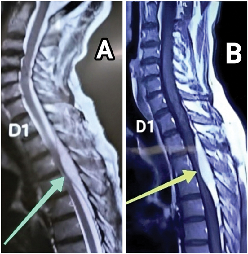 Spinal Extradural Angiolipoma: A Report of Two Cases and Review of Literature.