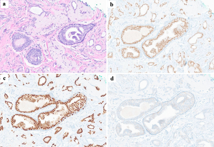 Successful Sentinel Lymph Node Biopsy in Accessory Breast Cancer.