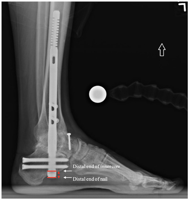 Complications and Early-Term Radiographic Analysis of a Novel Active Compression Tibiotalocalcaneal Arthrodesis Nail With a Proximal Flexible Coil.
