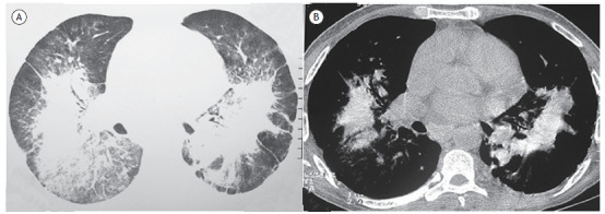 Pulmonary talcosis due to aspiration.