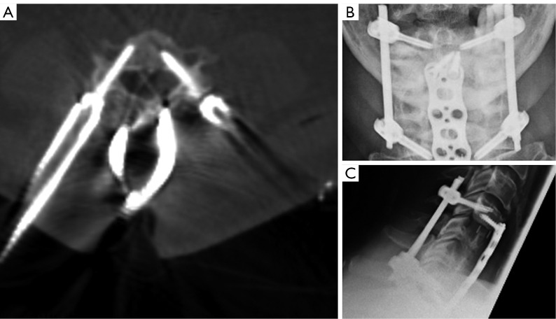 A new minimally invasive cervical pedicle screw (CPS) fixation system using intra-operative computed tomography-guided navigation.